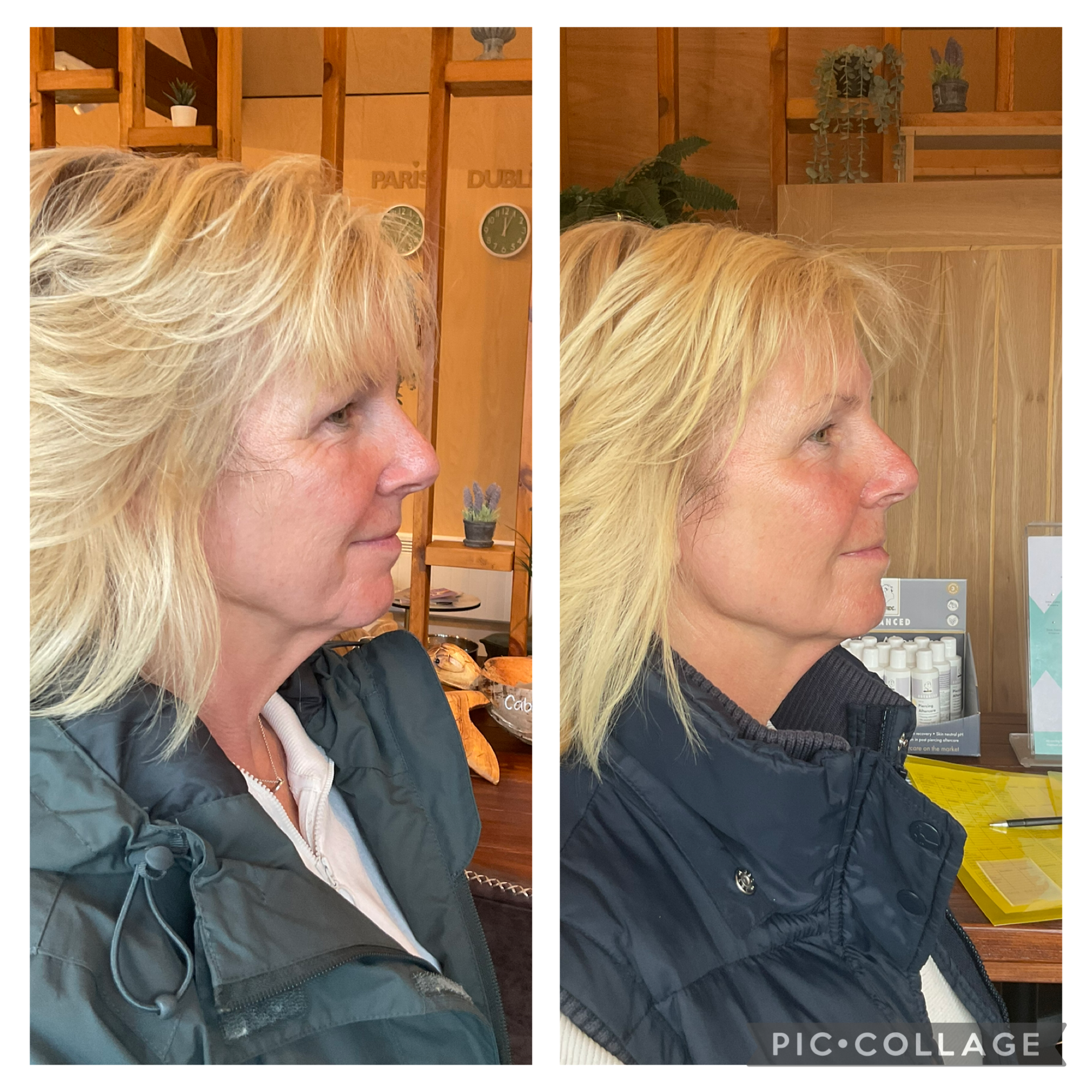 Comparison of side profile of woman with blonde hair wearing black jacket and white top, before and after a cosmetic or hair treatment, inside a room with wooden shelving and green plants.