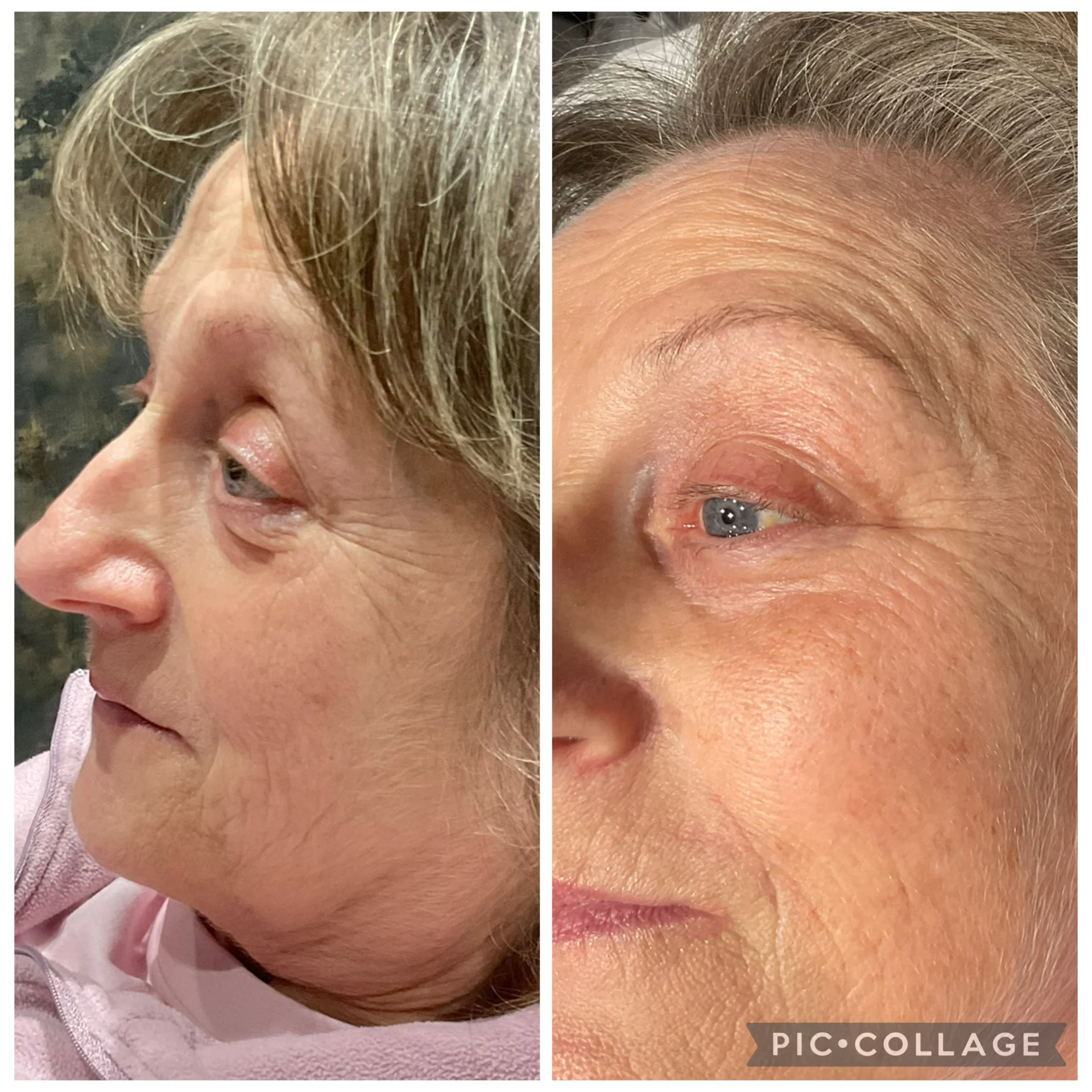 Side by side comparison of a woman's face before and after skincare treatment, focusing on forehead, eye area, and skin texture.