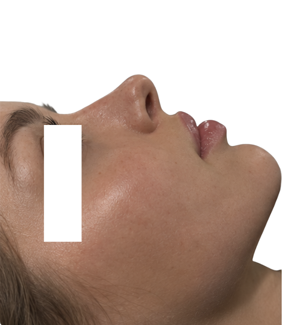 Non-Surgical Rhinoplasty