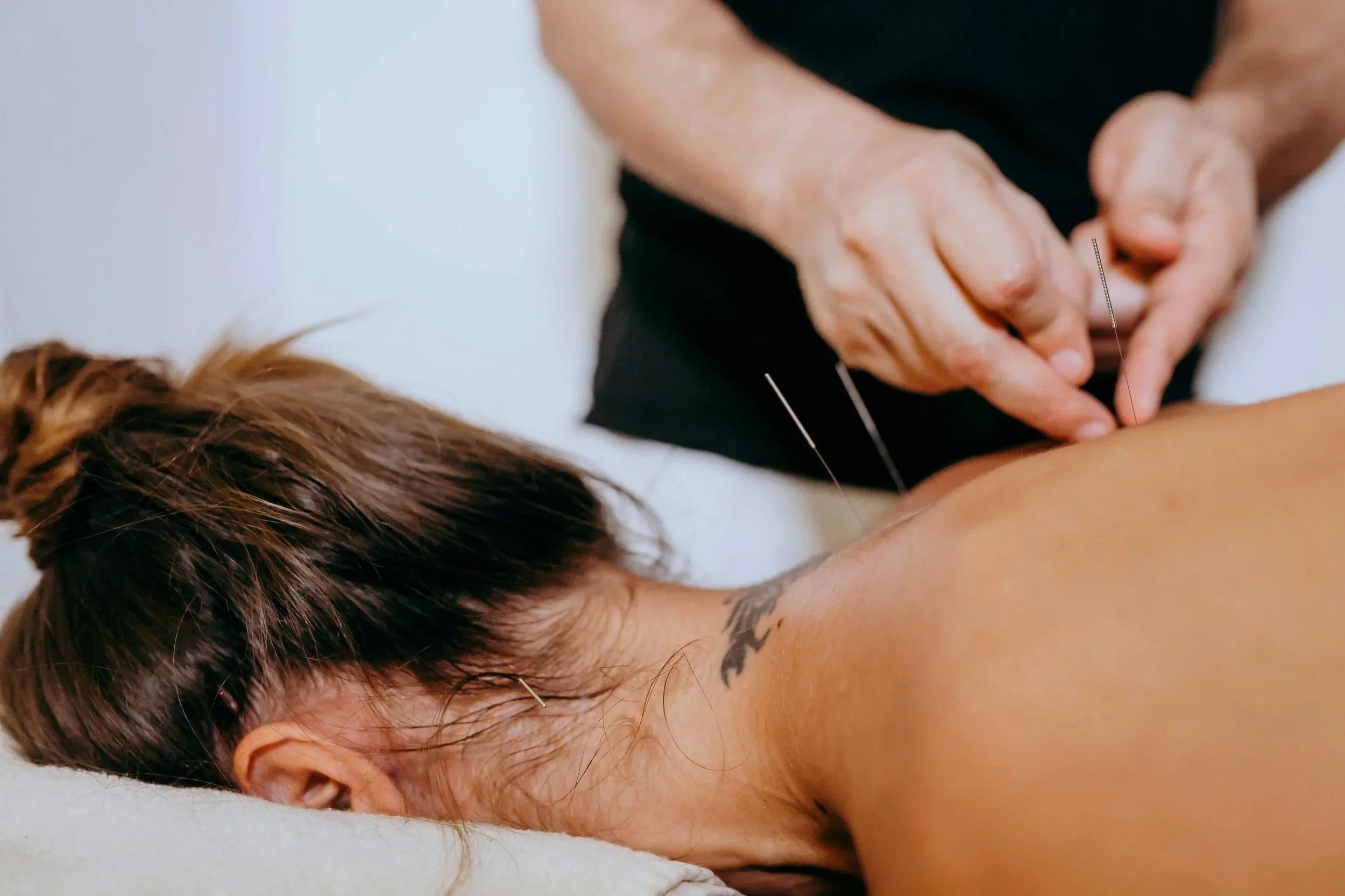 Dry needling treatment to the upper back and shoulder