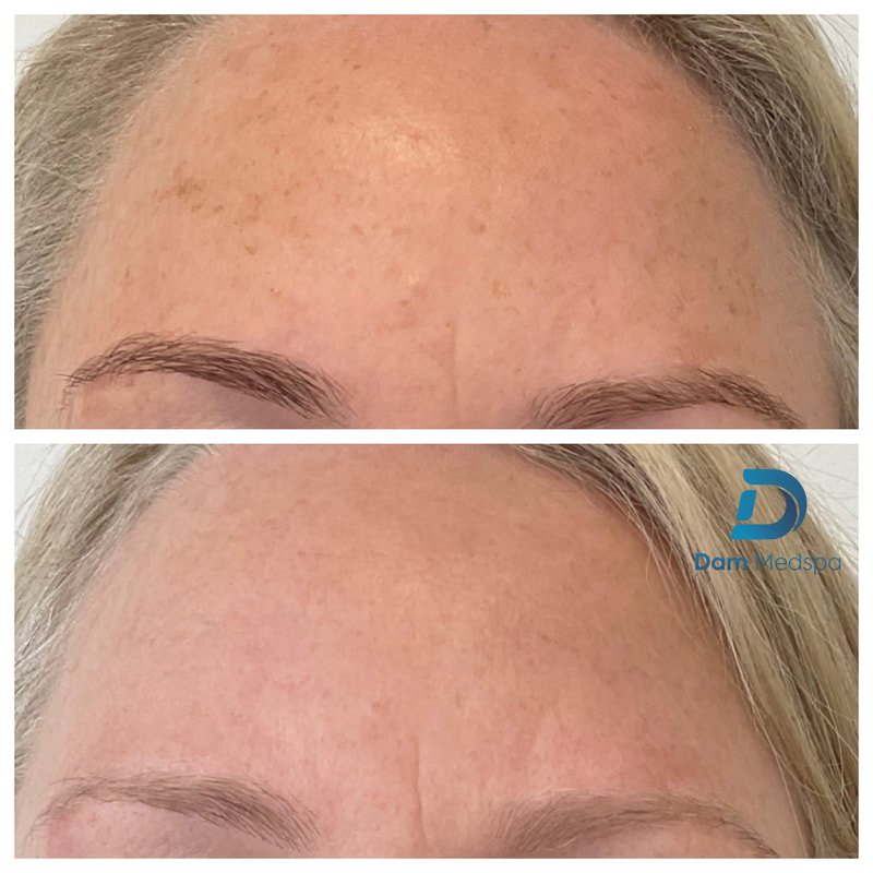 BBL Moxi sunspot age spot before and after Dam Medspa Dorchester Boston