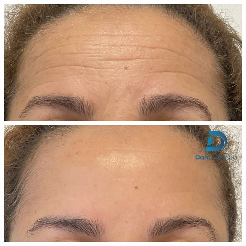 Forehead Botox natural looking before and after Dam Medspa Boston