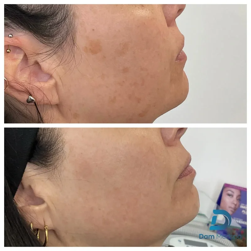 BBL Moxi hyperpigmentation before and after Dam Medspa Boston