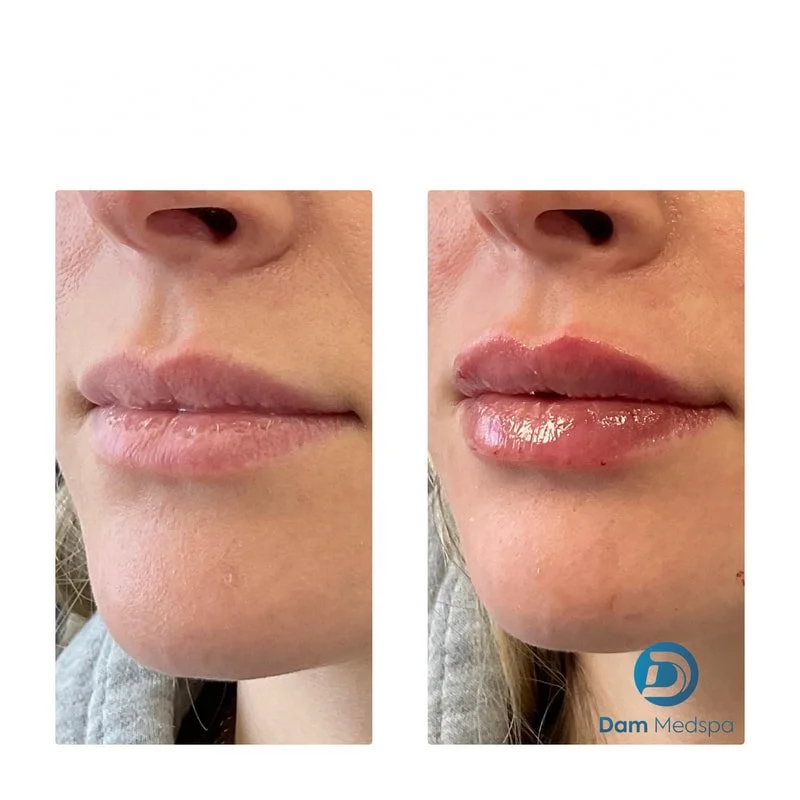 Lip filler before and after at Dam Medspa Dorchester Boston