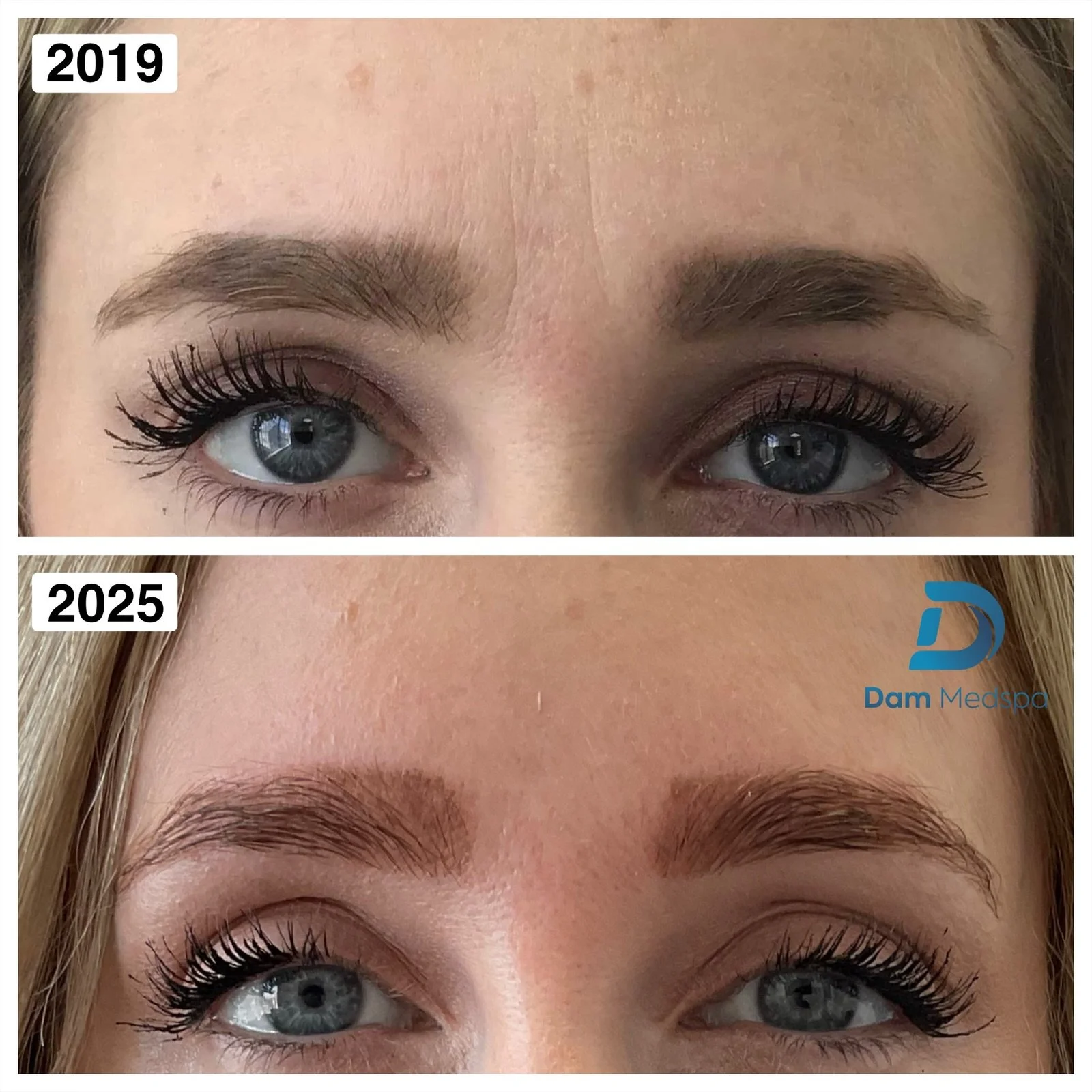 Frown lines Botox before and after at Dam Medspa Dorchester Boston