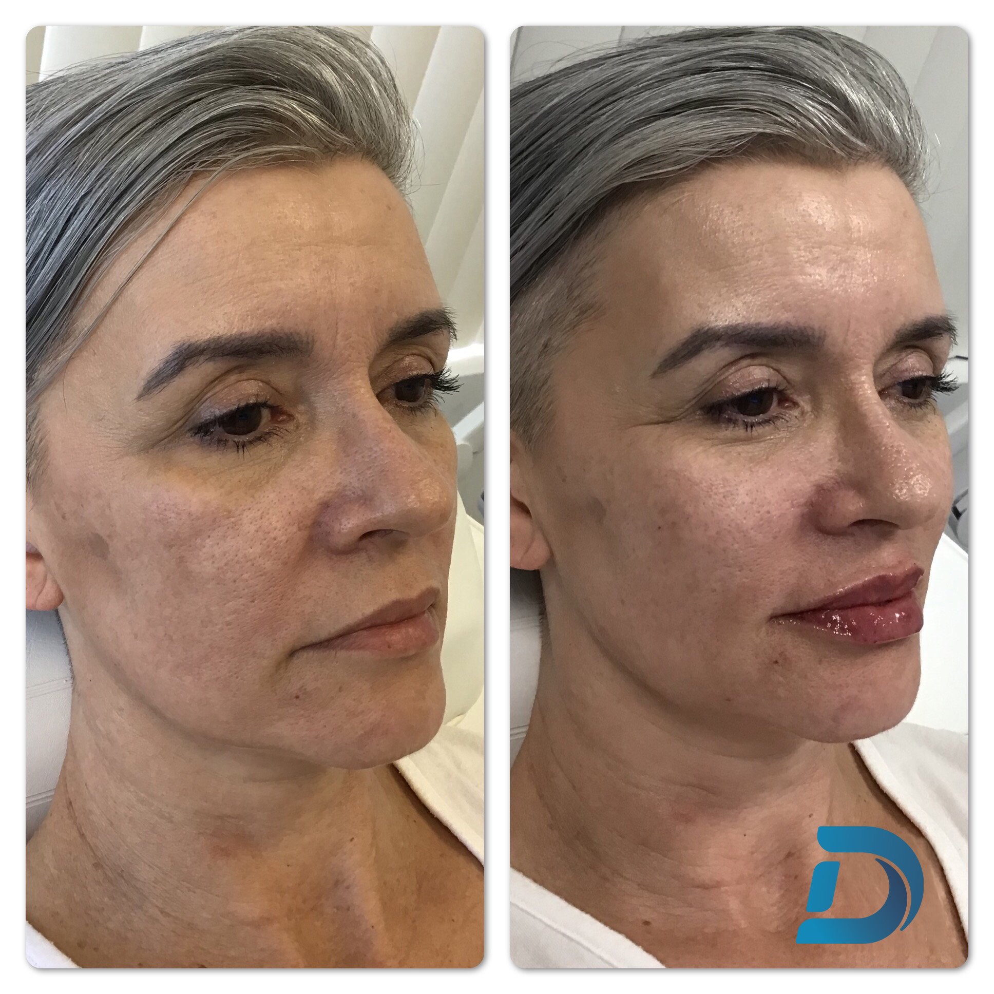 Full face balancing filler before and after Boston MA