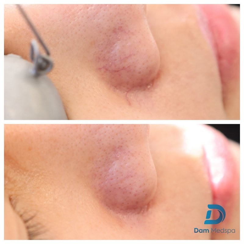 BBL photofacial treatment at Dam Medspa Dorchester Boston