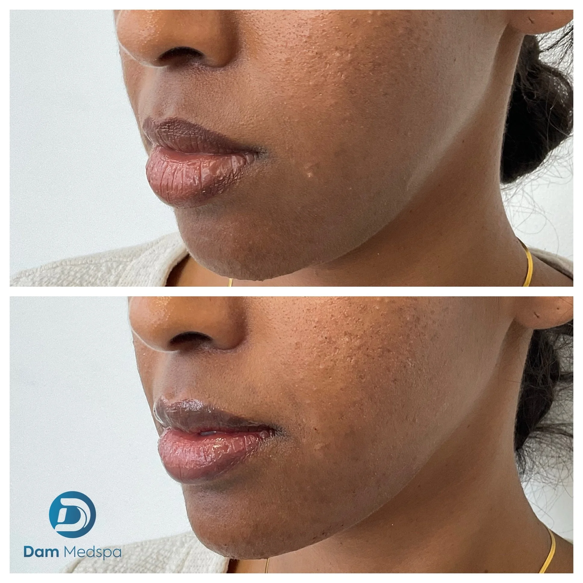 Chin filler before and after Dam Medspa Boston