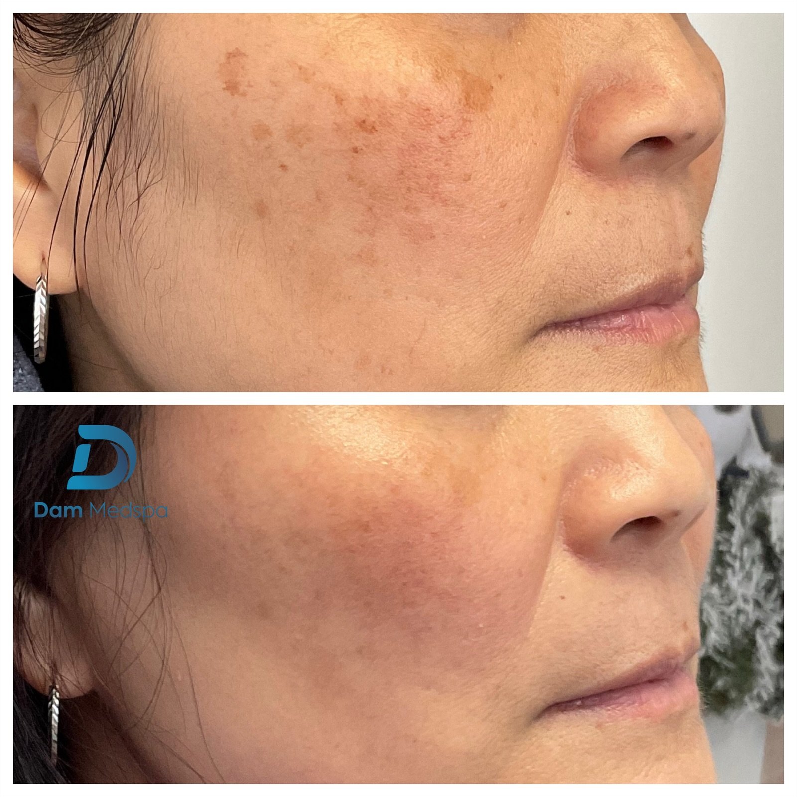 Moxi BBL hyperpigmentation age spot before and after Boston