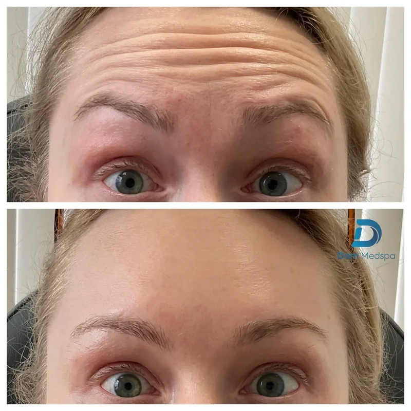 Forehead Botox before and after at Dam Medspa Boston