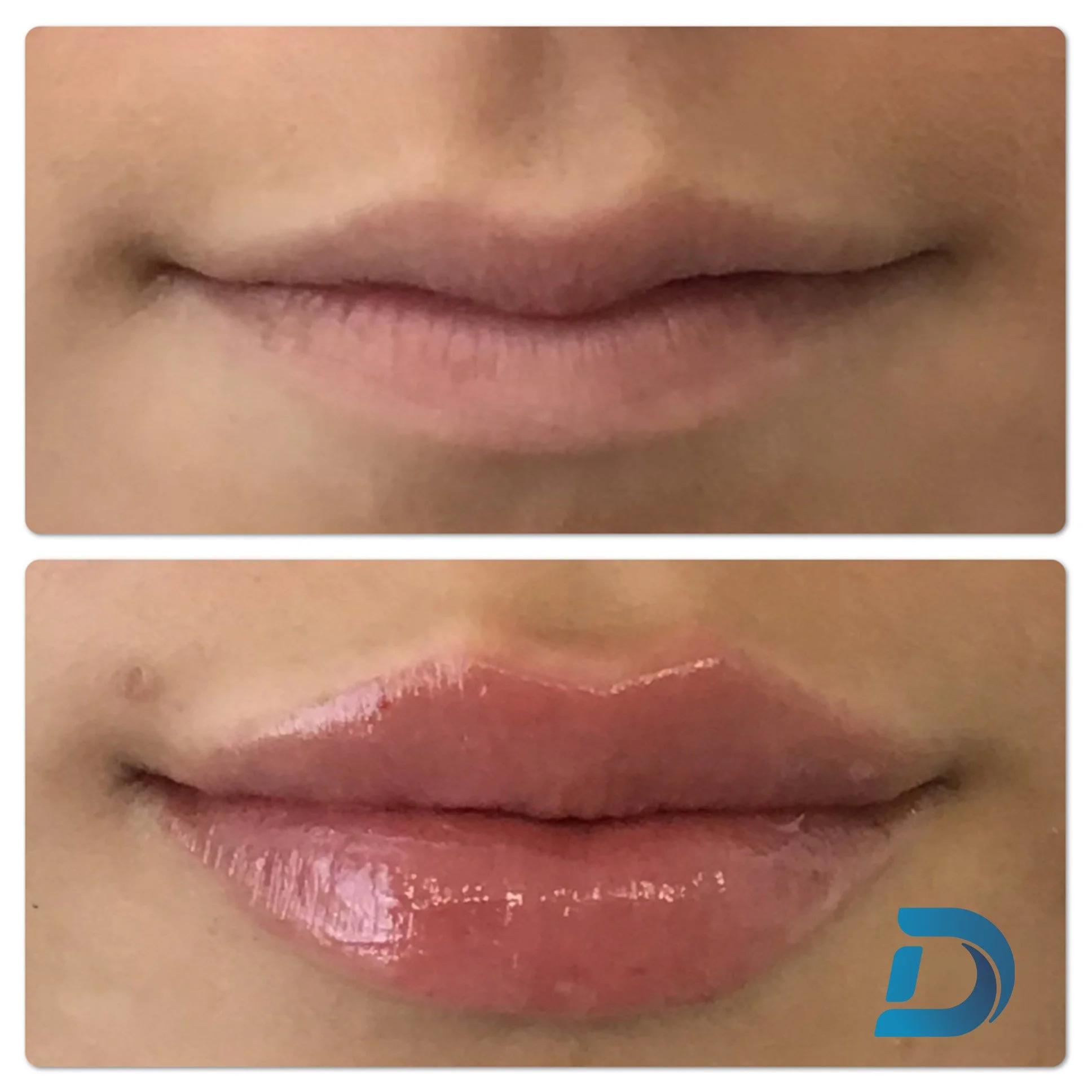 Natural lip filler close-up before and after Dam Medspa