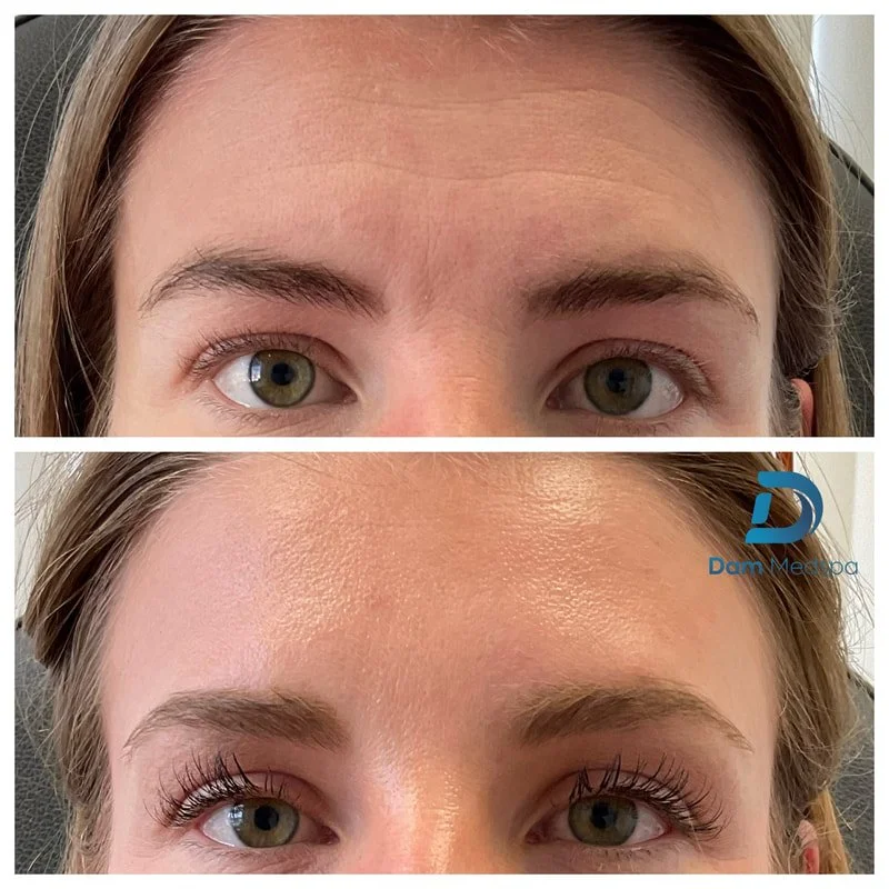 Forehead Botox before and after at rest Dam Medspa Boston