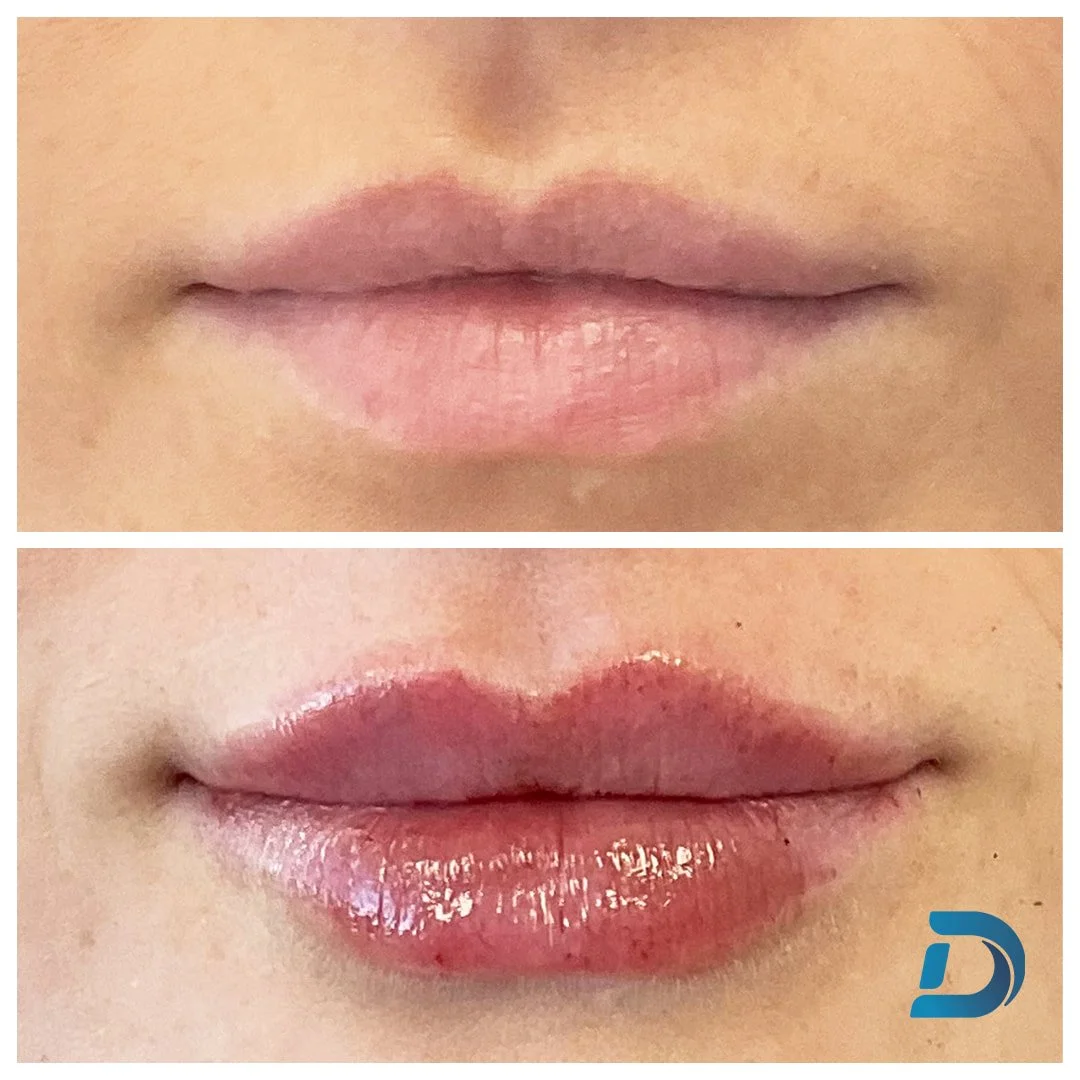 Subtle lip filler before and after Boston