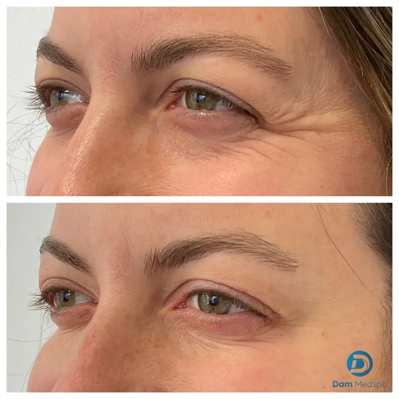 Crow's feet Botox before and after Dam Medspa Dorchester