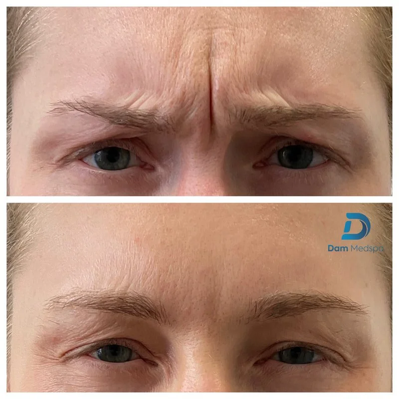 Botox frown line treatment before and after Dam Medspa Dorchester