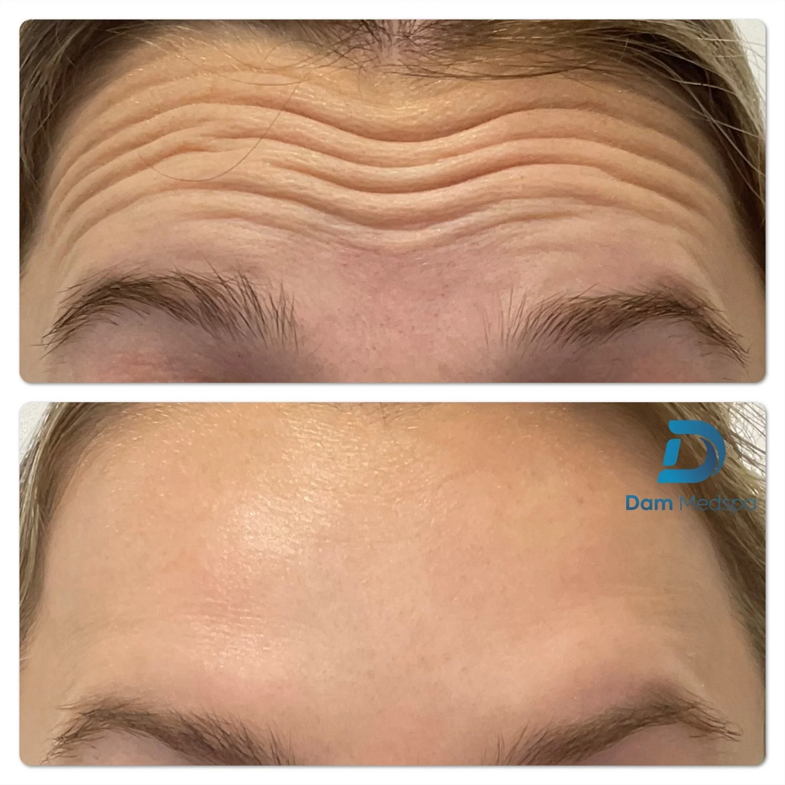 Forehead wrinkles Botox before and after Dam Medspa Boston
