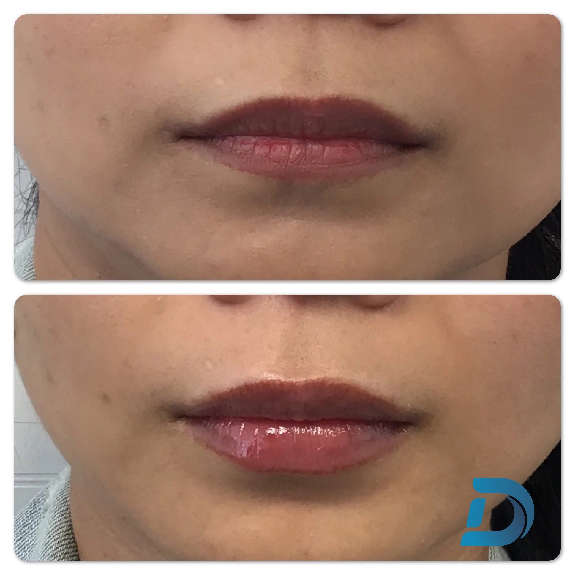 Lip filler with balanced shape before and after Boston