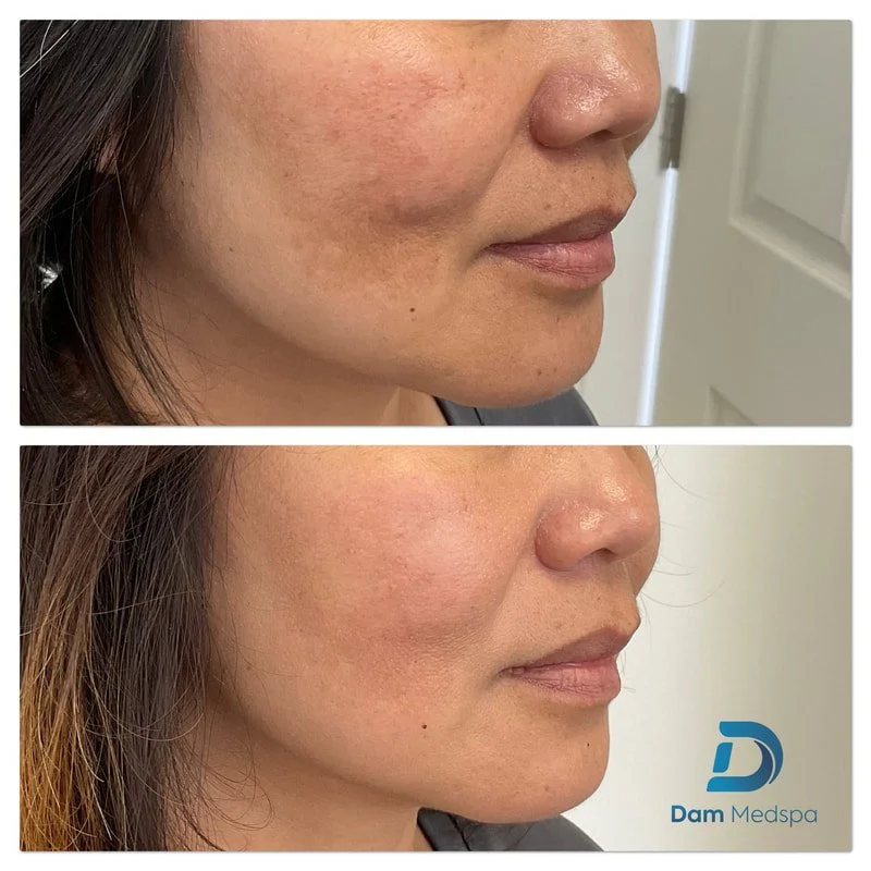 Moxi laser for melasma before and after Dam Medspa Dorchester