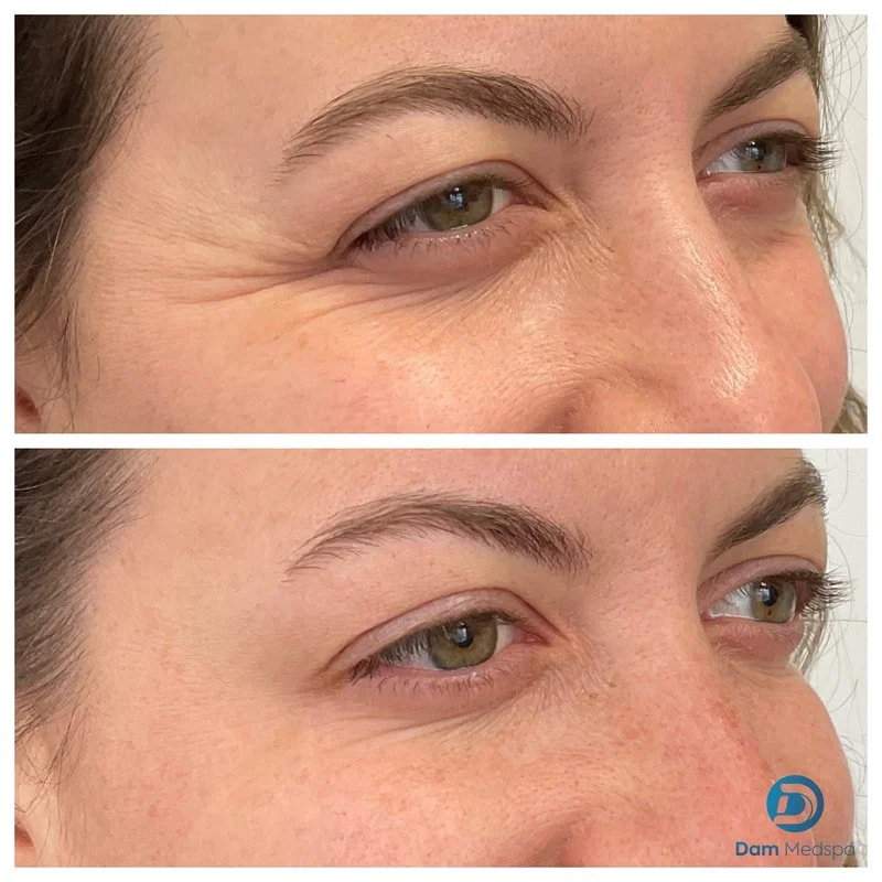 Crow's feet Botox before and after Dam Medspa Dorchester