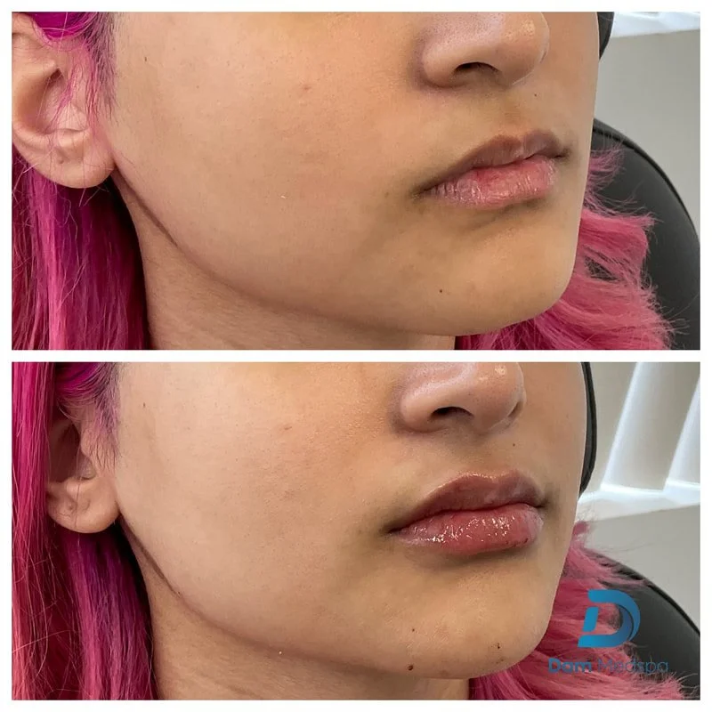 Chin and lip filler combination before and after Dam Medspa Dorchester