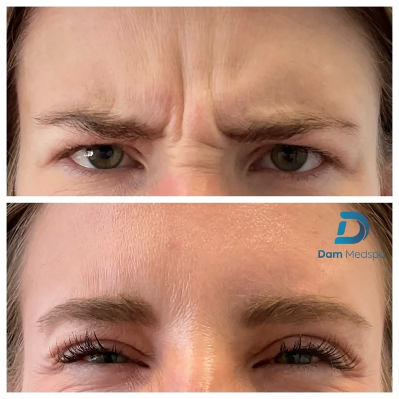 Frown lines Botox before and after Dam Medspa Boston