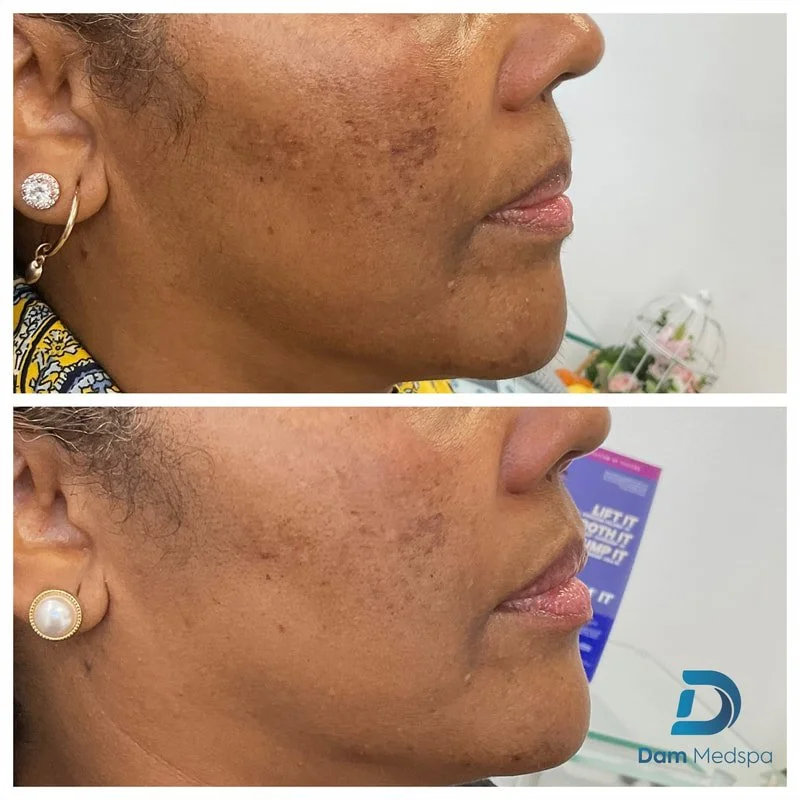 Moxi laser for dark skin before and after Dam Medspa Boston