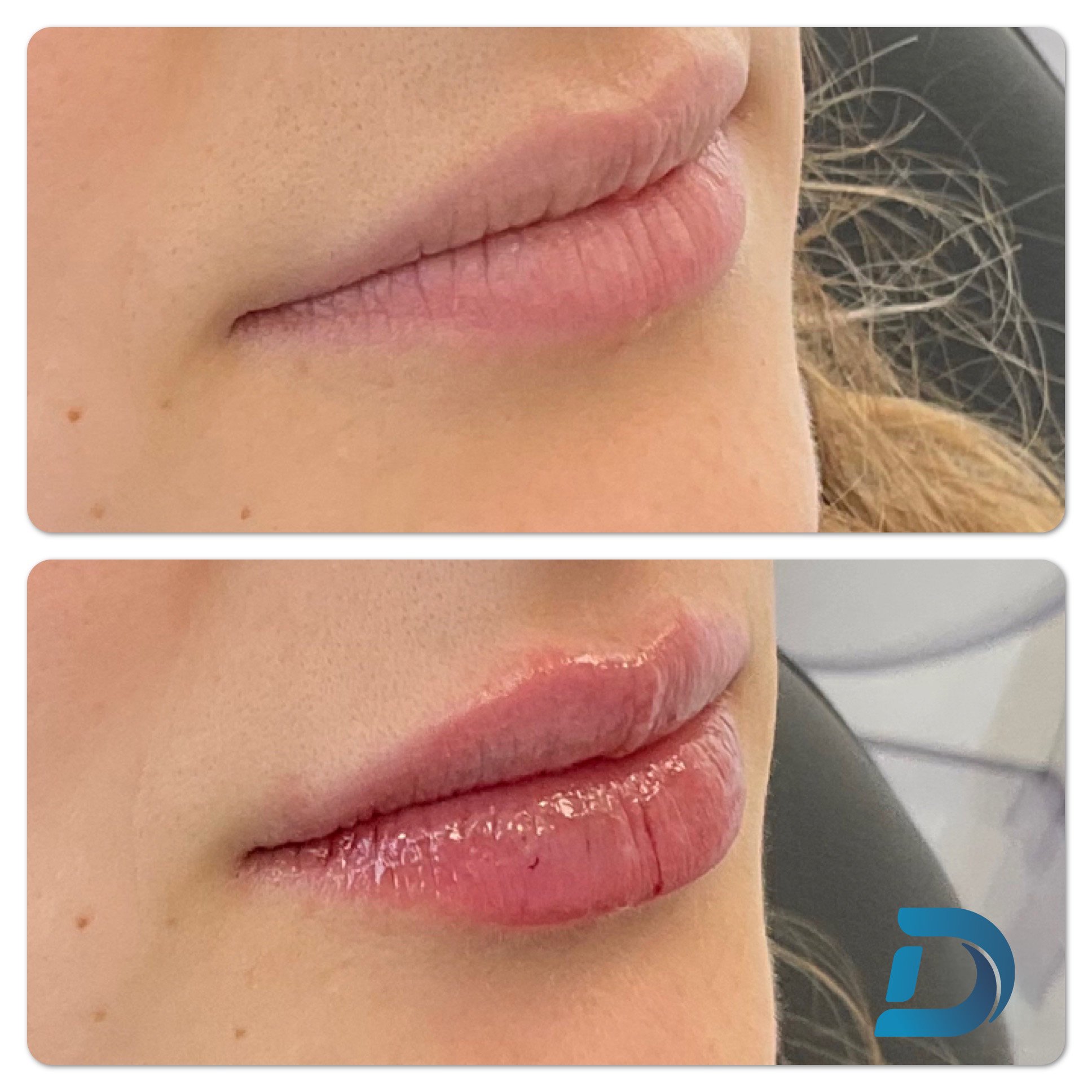 Lip filler before and after Dam Medspa Dorchester Boston
