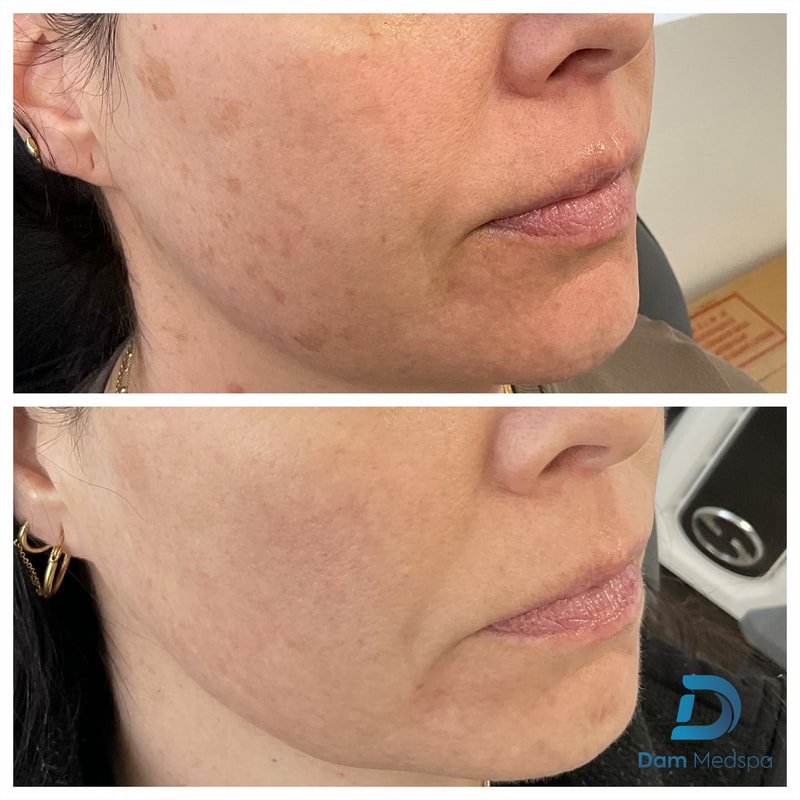 BBL and Moxi hyperpigmentation before and after Dam Medspa Boston