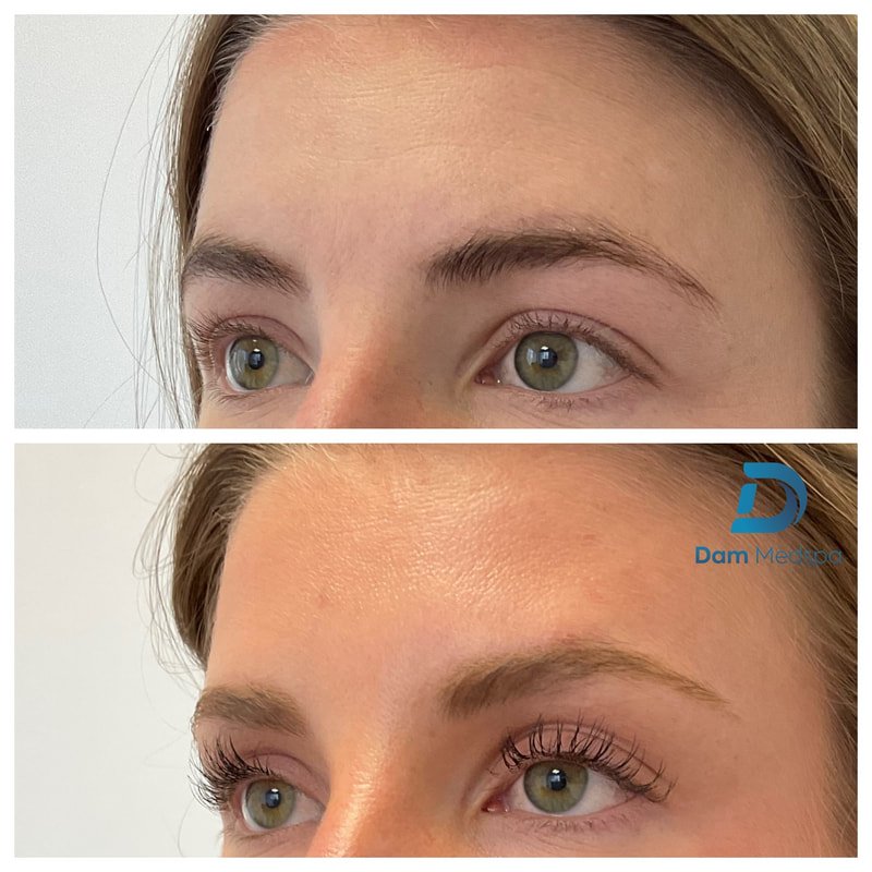 Forehead Botox before and after left profile at Dam Medspa Dorchester Boston