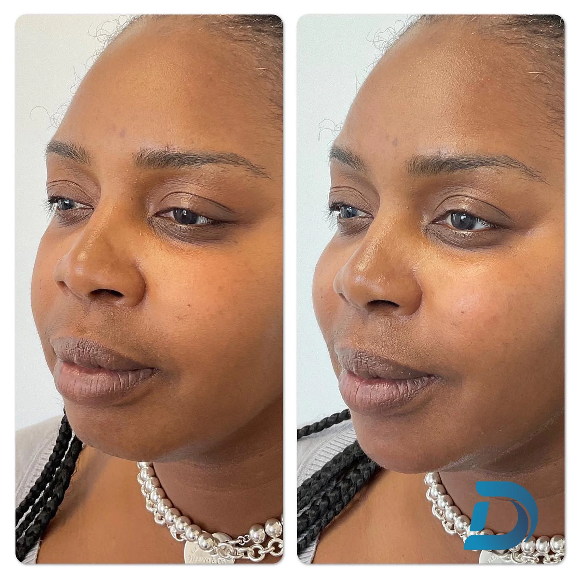 Facial balancing dermal filler before and after Dorchester Boston
