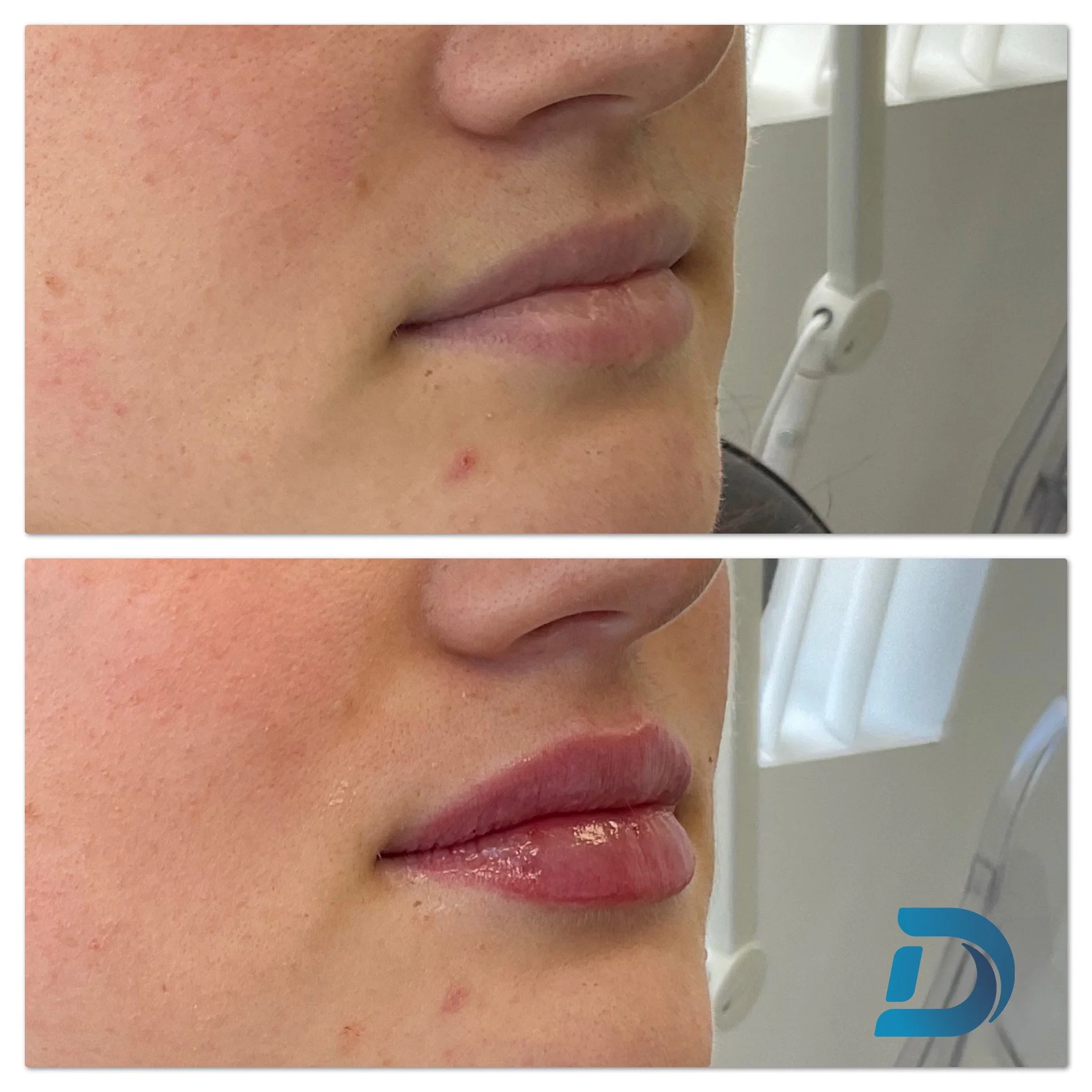 Natural lip filler before and after results at Dam Medspa Dorchester Boston