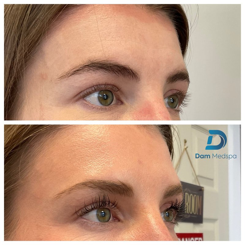 Forehead Botox before and after right profile at Dam Medspa Dorchester Boston
