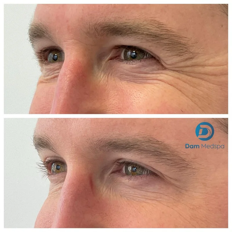 Men's crow's feet Botox before and after at Dam Medspa Boston