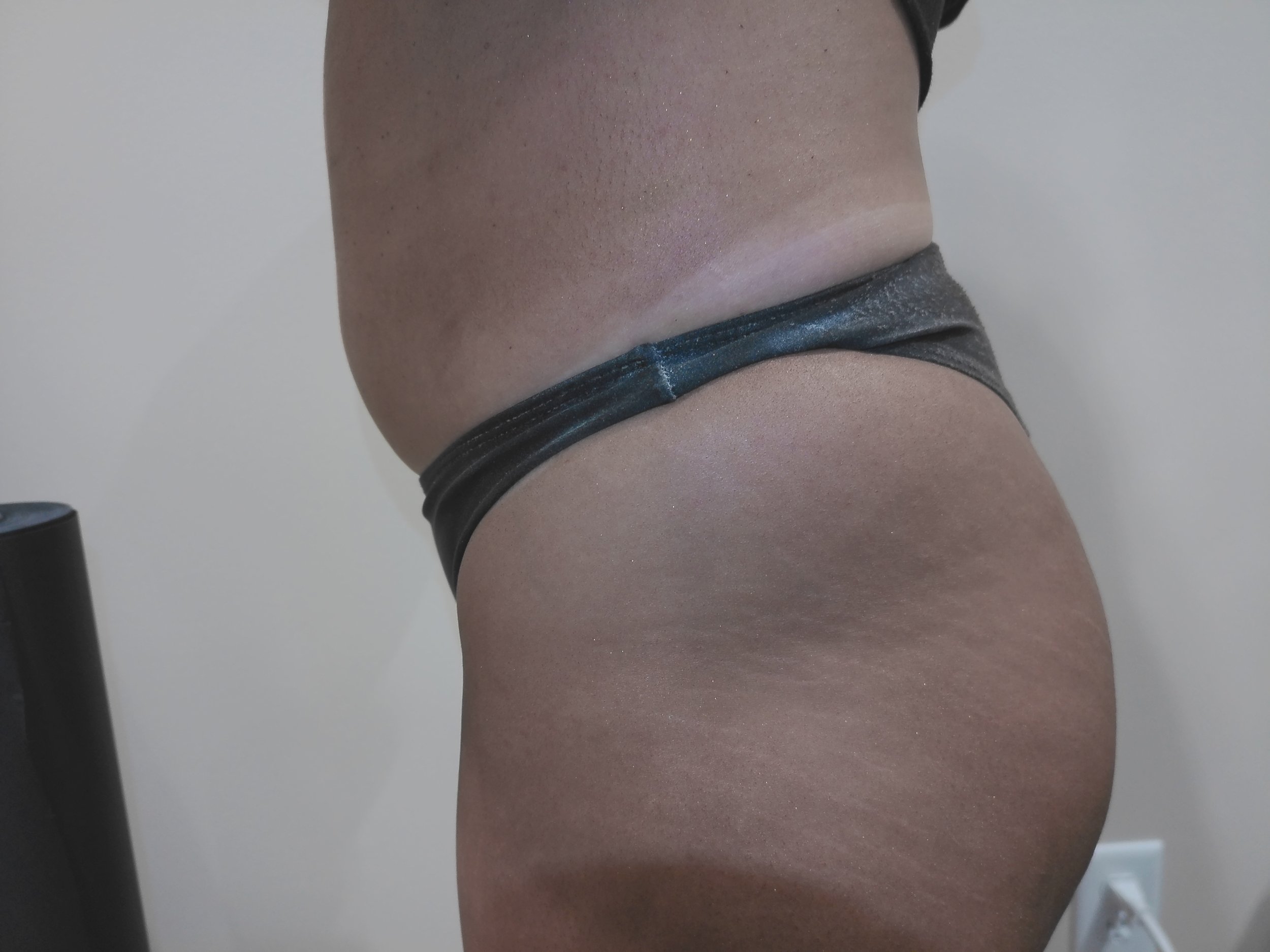 Client 2 - Hip After 
*Note - Client Selected Our Sun Kissed Shimmer Finish Powder