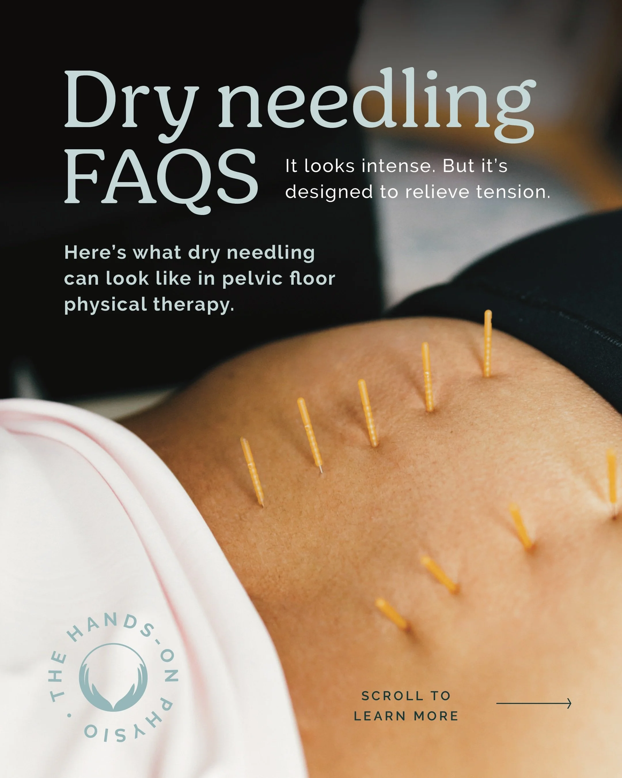 If you&rsquo;ve seen dry needling and thought, &ldquo;Absolutely not,&rdquo; you&rsquo;re not alone. 😅

It may look intense, but the goal is relief.

Your pelvic floor does not work in isolation. Tension in the hips, glutes, abdomen, low back or pel