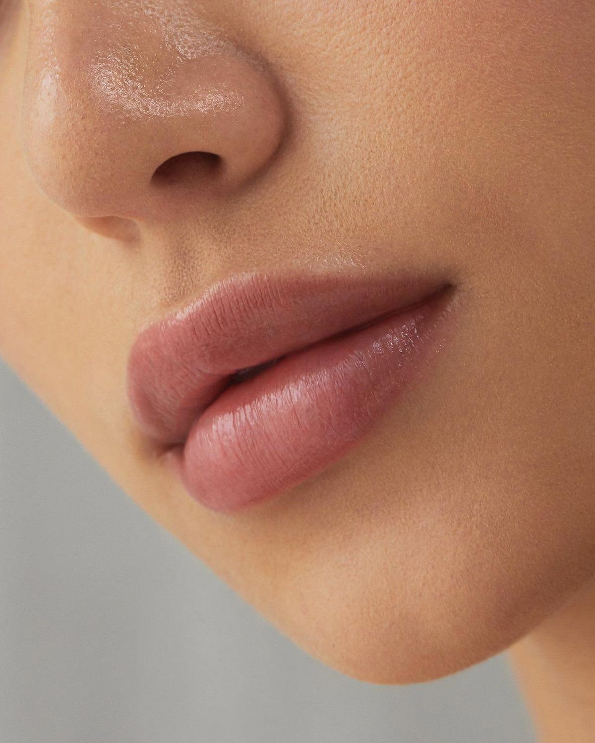 Dermal Lip Filler