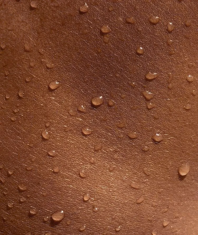 Hyperhidrosis