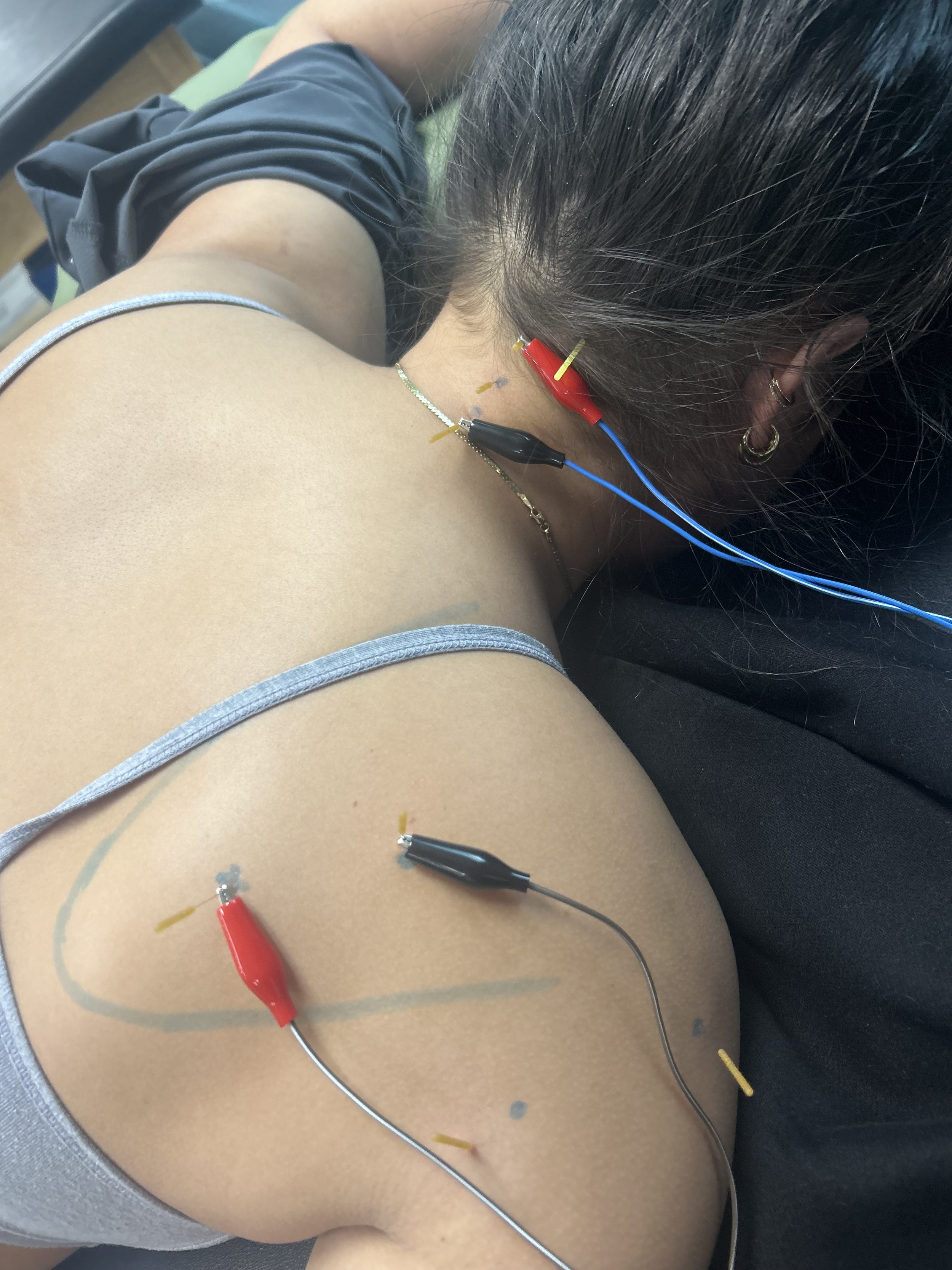 Person receiving an electrical acupuncture treatment on their shoulder with wired acupuncture needles and alligator clips.