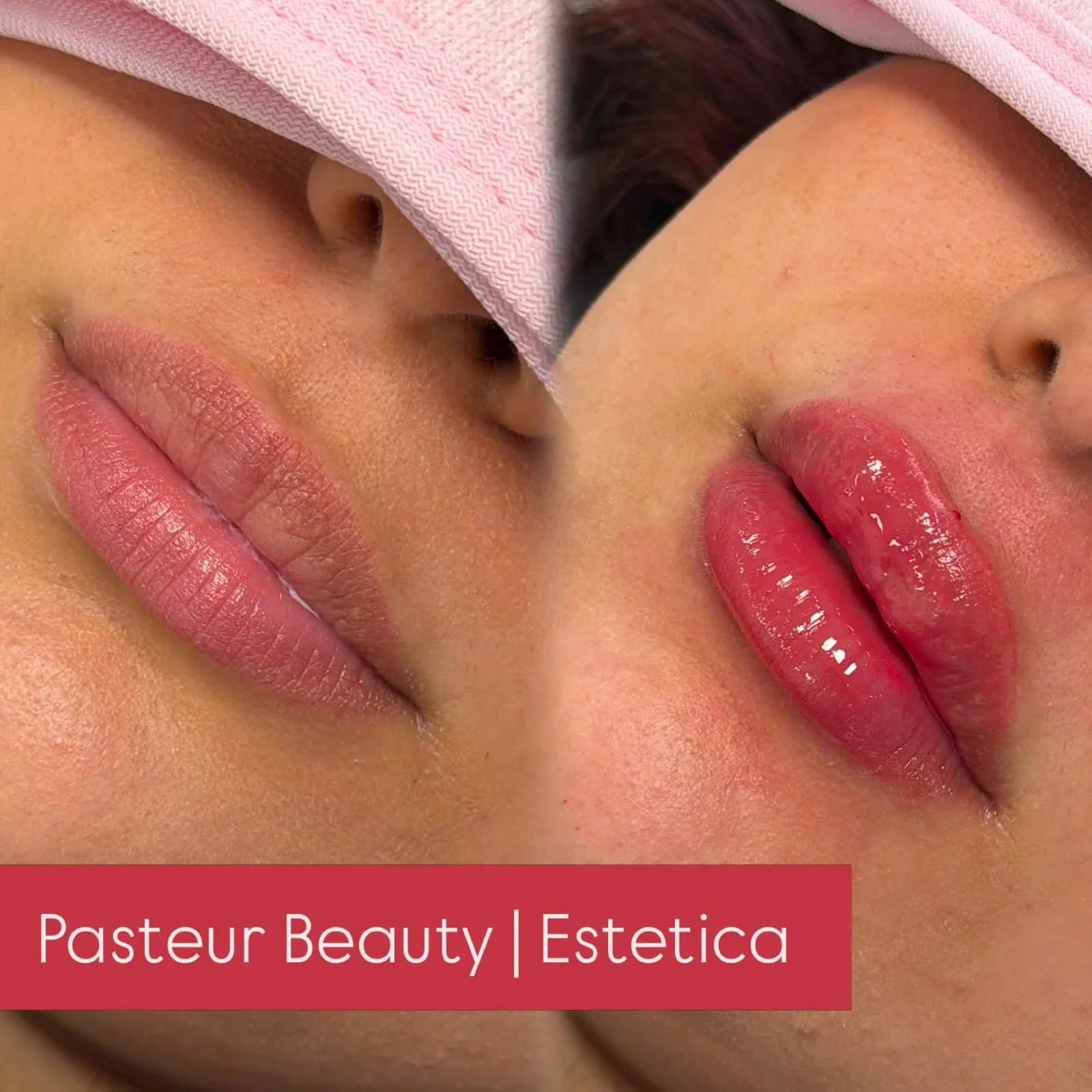 📍 Hamburg
&bull;
&bull;
&bull;
&bull;
&bull;
#hamburg #botox #hyaluron #lippen #endolift