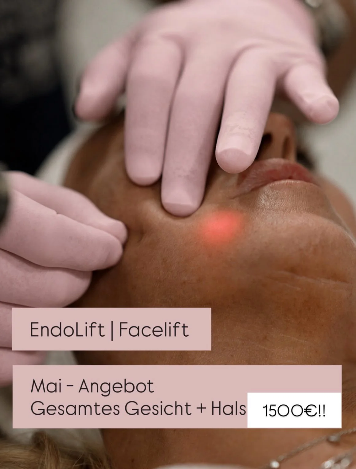 ✨ Endolift ist eine moderne, minimalinvasive Laserbehandlung zur Hautstraffung und Konturverbesserung &mdash; ganz ohne klassische Operation. Dabei werden extrem feine Laserfasern unter die Haut eingef&uuml;hrt, um das Gewebe von innen zu erw&auml;rm