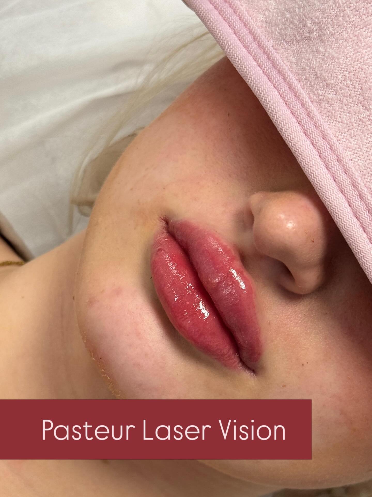 📍 Hamburg | 1 ml Lip Filler
&bull;
&bull;
&bull;
#hamburg #harburg #beauty #sch&ouml;nheits #botox