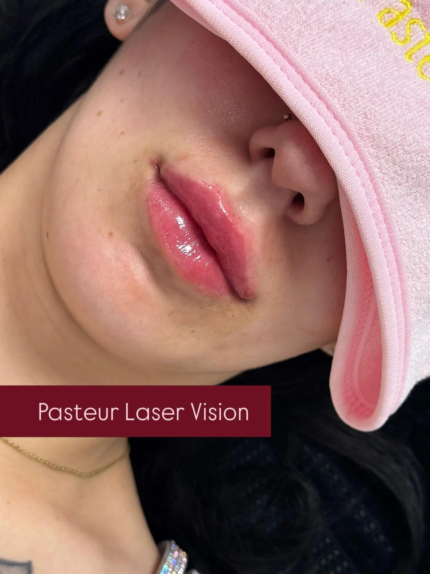 📍Hamburg | Lip Filler 🤍
&bull;
&bull;
&bull;
&bull;
&bull;
#lipfiller #harburg #hamburg #jungfernstieg #botox