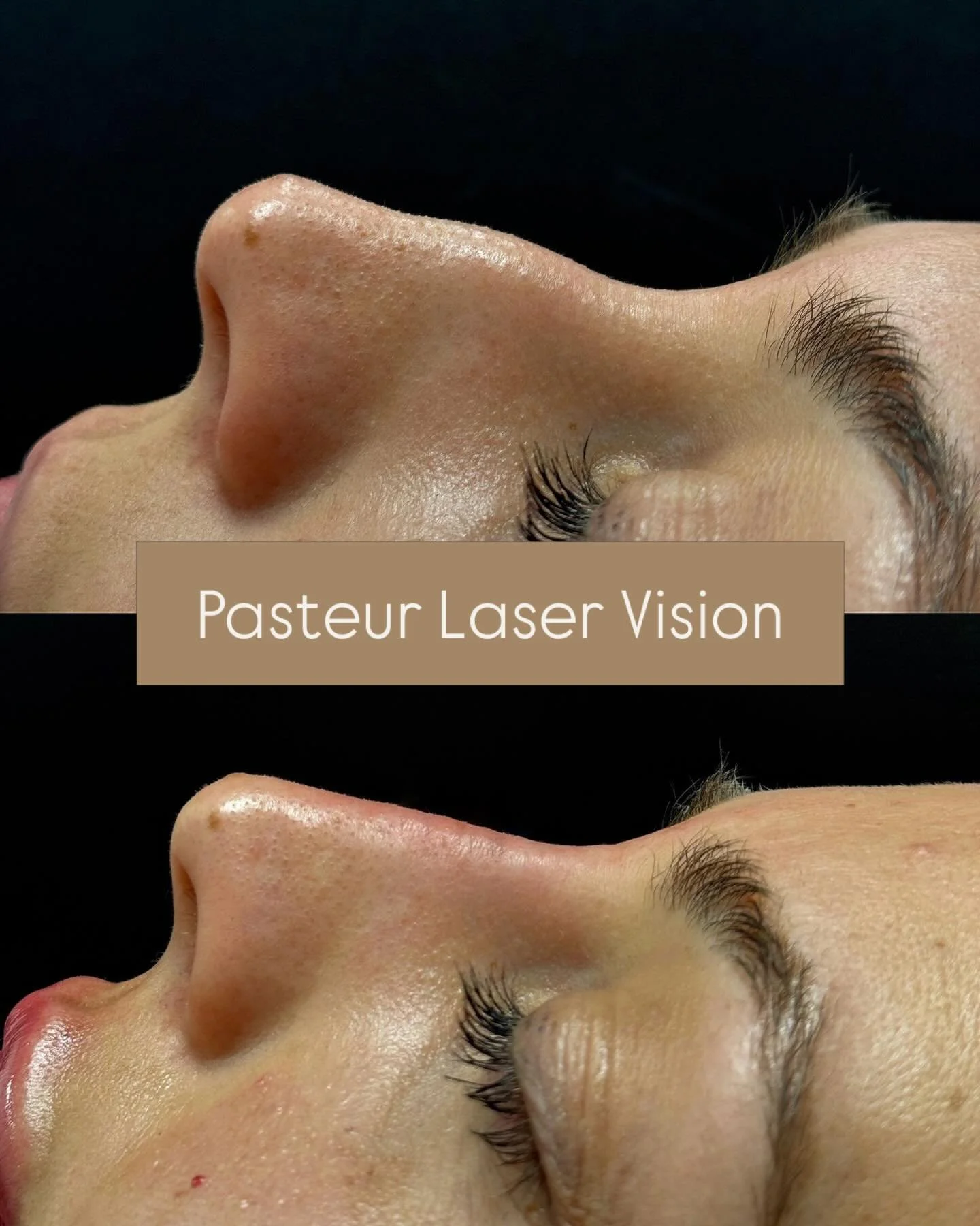 📍 Pasteur Laser Vision
&bull;
&bull;
&bull;
&bull;
&bull;
#rhinoplasty #nosejob #nosefiller #hamburg #jungfernstieg