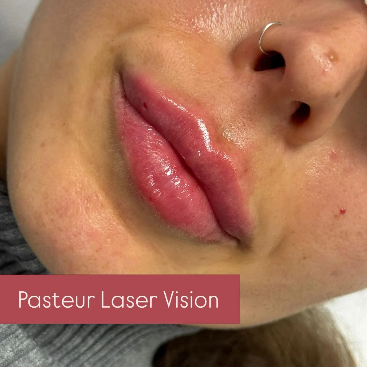📍 Pasteur Laser Vision 
&bull;
&bull;
&bull;
&bull;
&bull;
#hamburg #harburg #jungfernstieg #lipfiller #botox