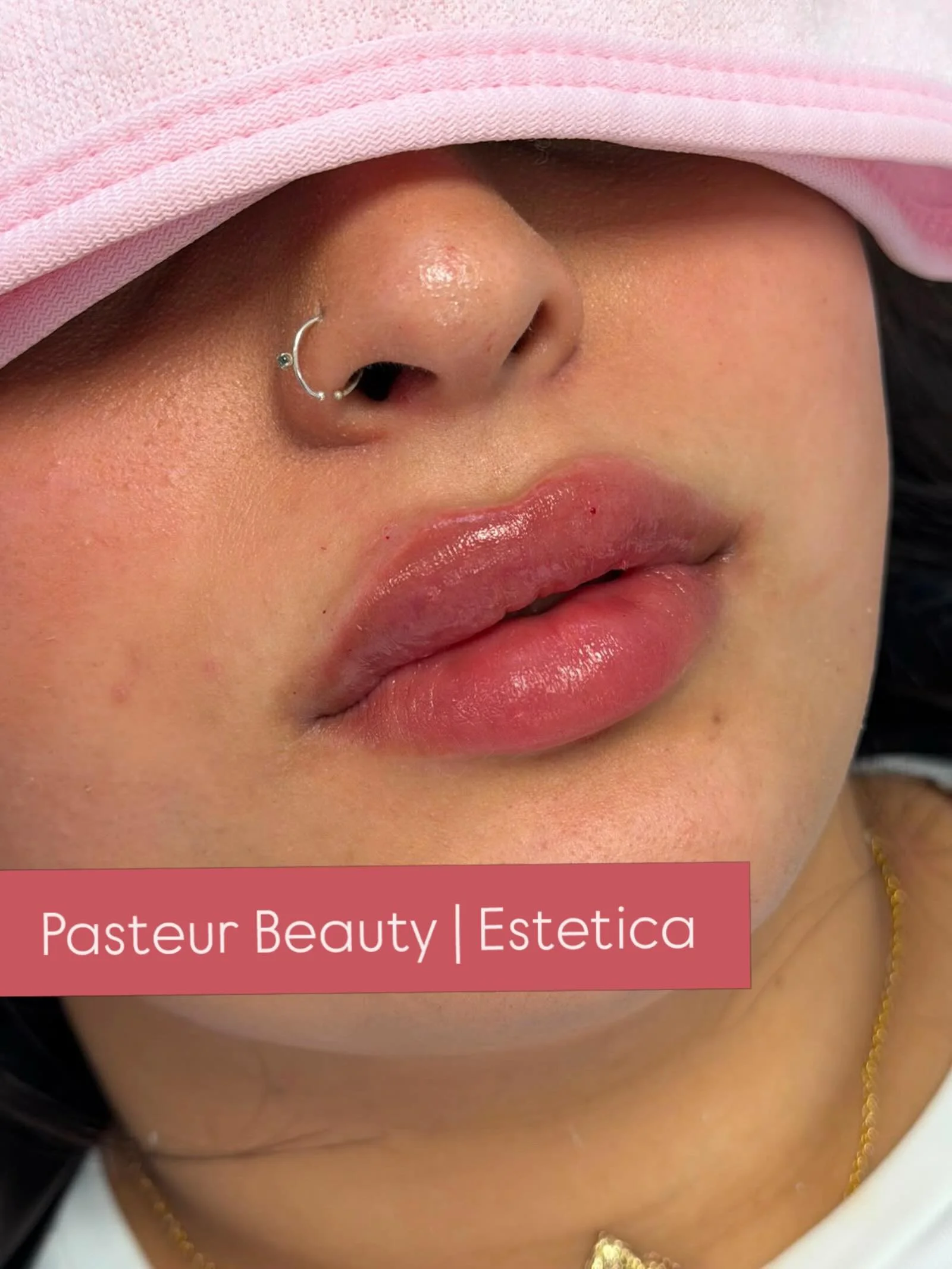 &bull;
&bull;
&bull;
&bull;
&bull;
#hamburg #sch&ouml;nheitsklinik #botox #hyaluron