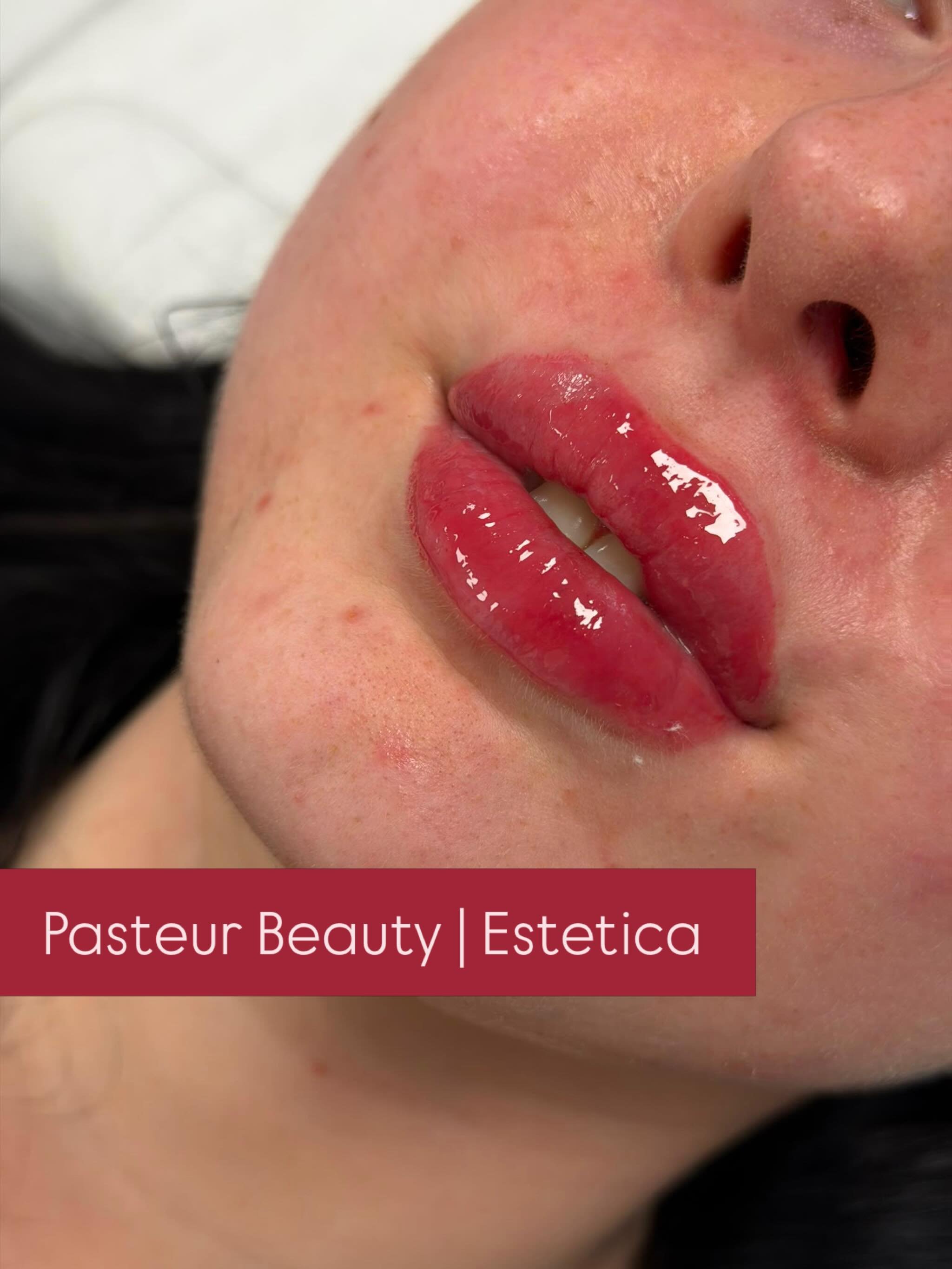 📍 Hamburg
&bull;
&bull;
&bull;
&bull;
&bull;
#sch&ouml;nheitsklinik #pasteurbeauty #hyaluron #botox