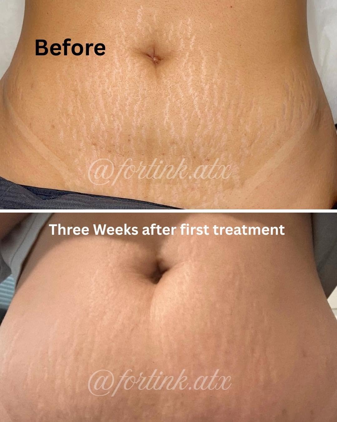 stretch marks 3.jpg