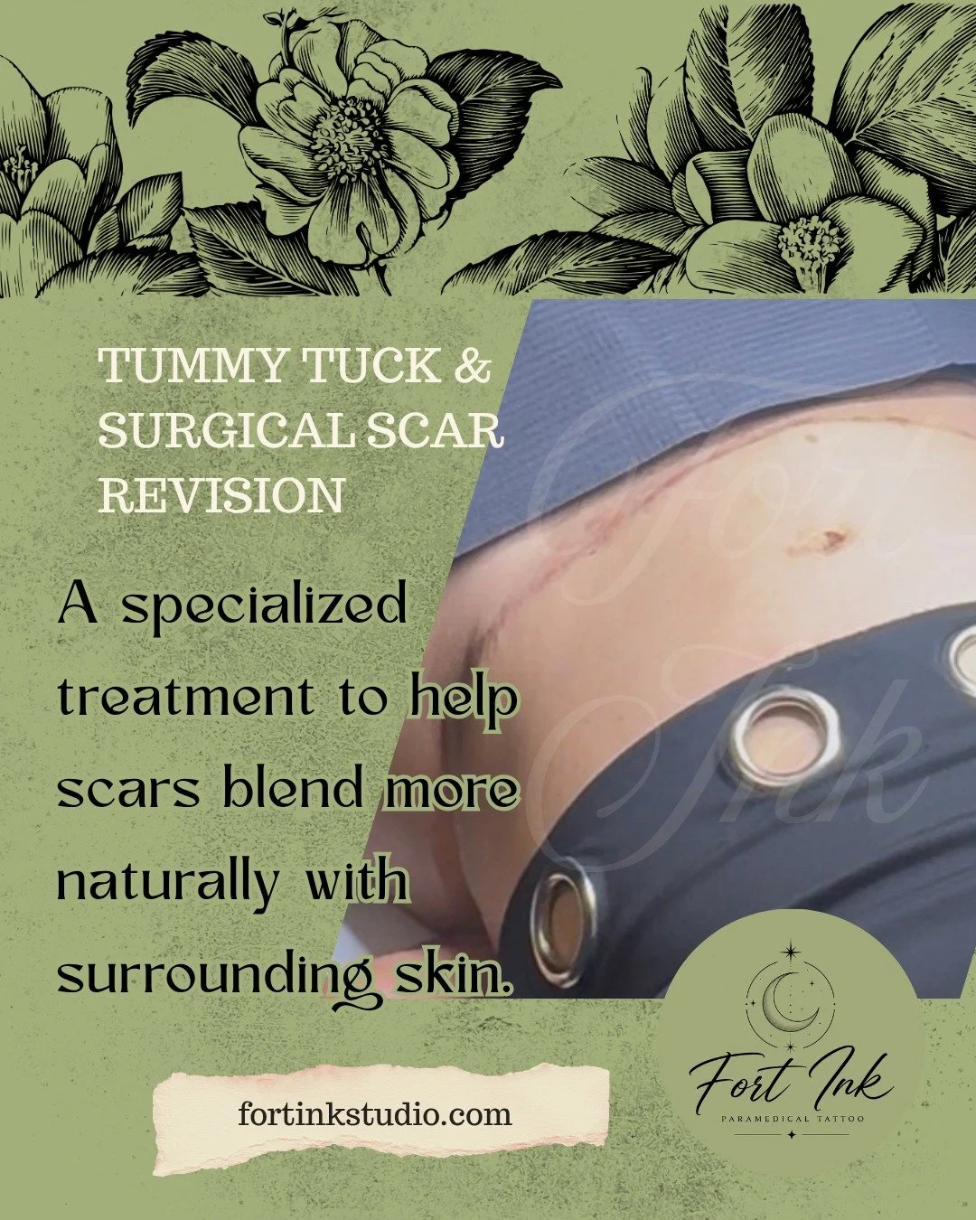 That scar tells a story&mdash;but it doesn't have to be the first thing you see. 💚

Tummy tuck scars are incredibly common, and for many people they're a reminder of a journey they're proud of. For others, they're something they'd like to soften and