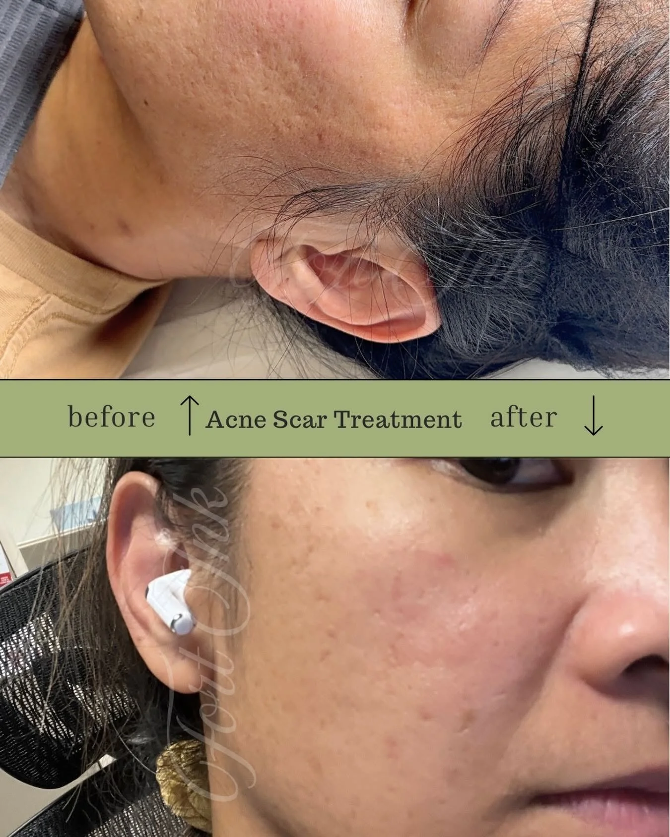 acne start treatment.jpg