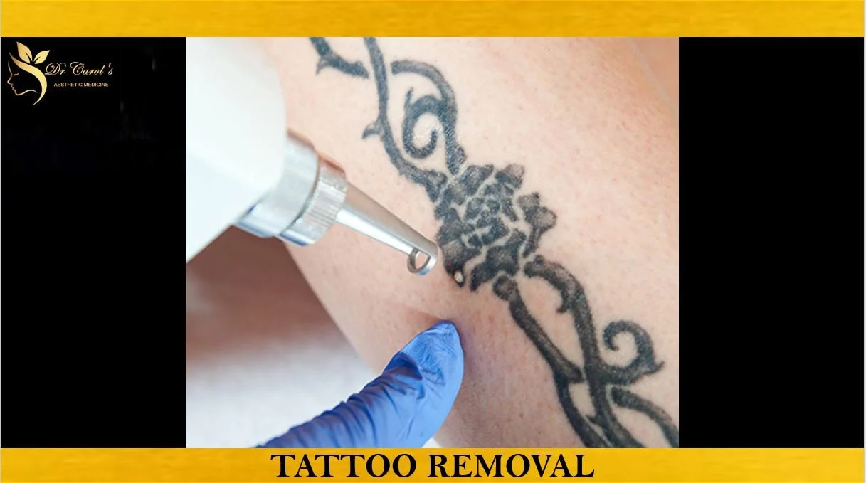 TATTOO REMOVAL.JPG